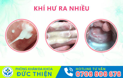 dấu hiệu viêm vùng kín