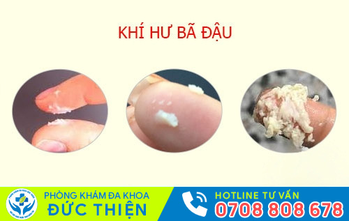 Hiện tượng khí hư bả đậu