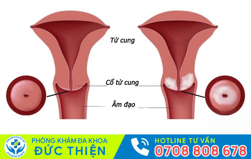 Các bệnh tử cung, cổ tử cung khiến kinh nguyệt có mùi hôi tanh