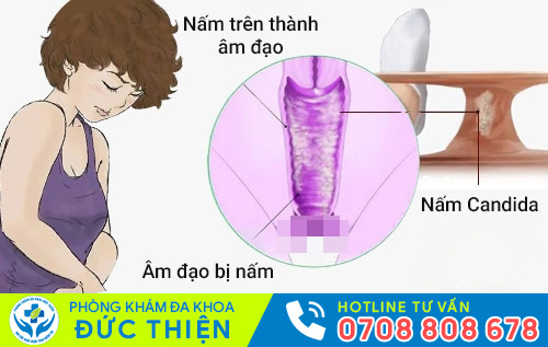 Sưng vùng kín do nấm âm đạo