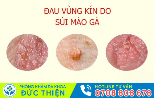 Hình ảnh đau vùng kín ở nữ do mắc sùi mào gà
