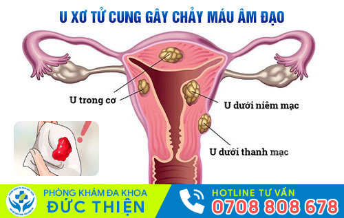 Nguyên nhân gây chảy máu âm đạo
