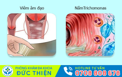 Nguyên nhân khí hư có mùi hôi