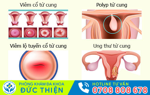 Nguyên nhân kinh nguyệt kéo dài