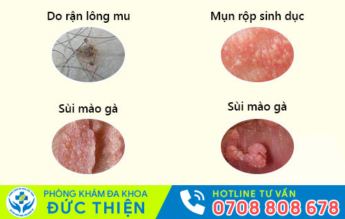 Ngứa cô bé do bệnh xã hội