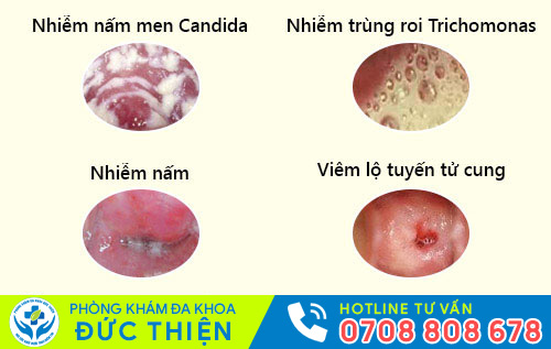 Nguyên nhân ngứa cô bé