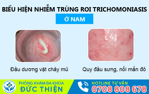 Nhiễm trichomonas ở nam giới