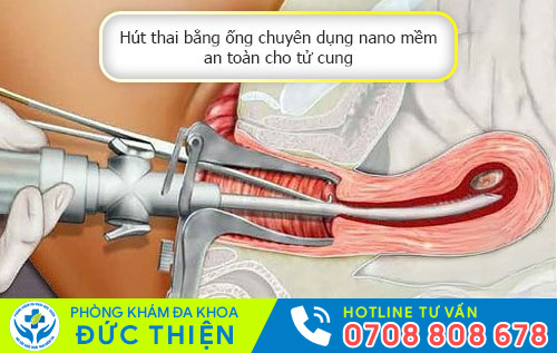 Phá thai bằng ống dẫn siêu mềm an toàn cho tử cung