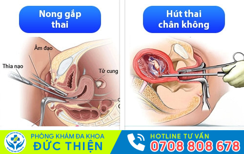 Hút thai chân không, nong gắp thai