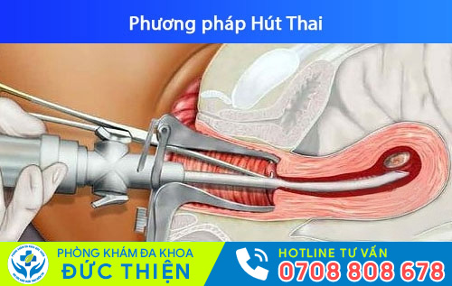 Bỏ thai 8 tuần bằng phương pháp hút thai
