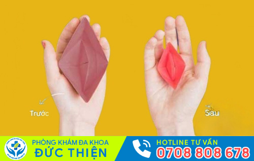 Phương pháp khâu màng trinh