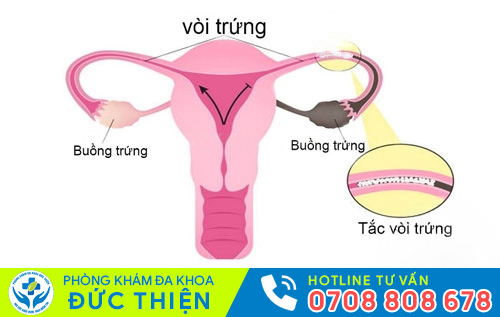 Tắc vòi trứng do viêm nhiễm kéo dài