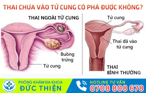 Thai chưa vào tử cung có phá được không