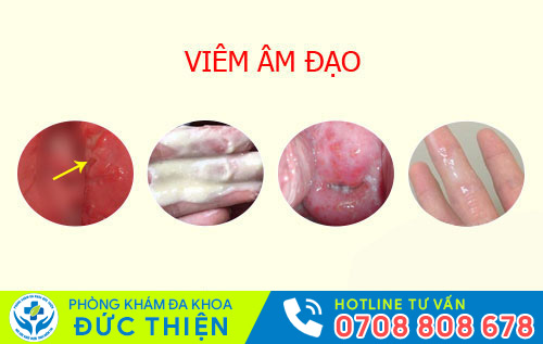 Viêm âm đạo