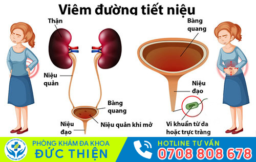 Viêm đường tiết niệu ở nữ giới