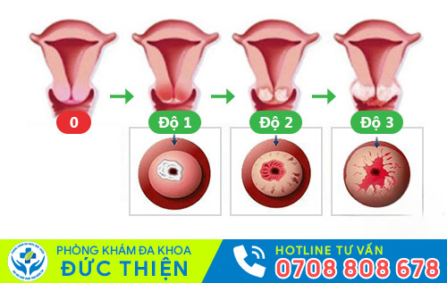 Hình ảnh bệnh viêm lộ tuyến cổ tử cung qua từng giai đoạn