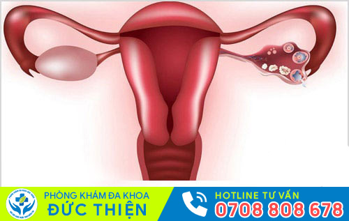 Hình ảnh bệnh viêm phần phụ