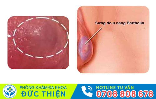 Viêm tuyến Bartholin