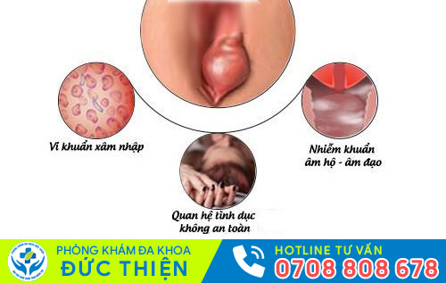 Viêm tuyến bartholin