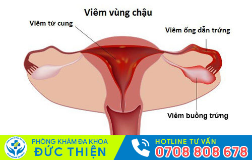 Viêm vùng chậu
