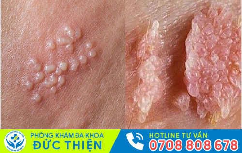 Bệnh chào mào hoa khế là bệnh gì?