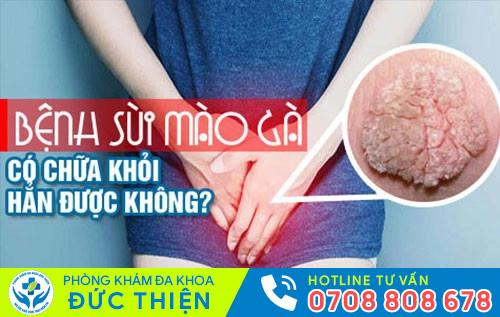 Sùi mào gà tái phát hay không?