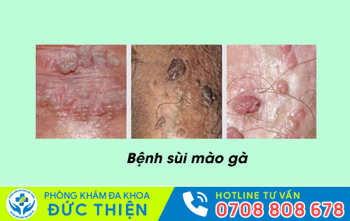 Sùi mào gà
