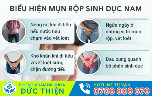 bieu hien benh mun rop sinh duc nam gioi