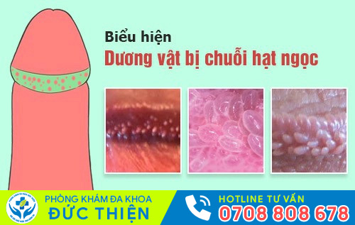 Chuỗi hạt ngọc dương vật