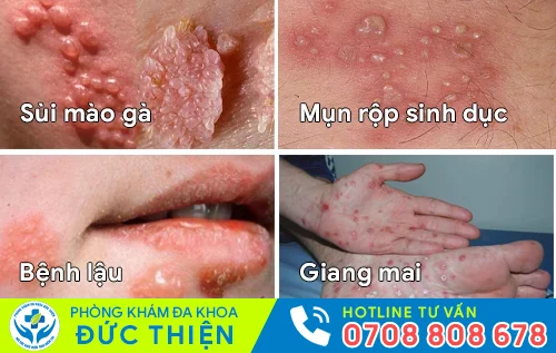 cac benh lay qua duong tinh duc