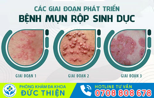 Biểu hiện mụn rộp sinh dục ở nữ