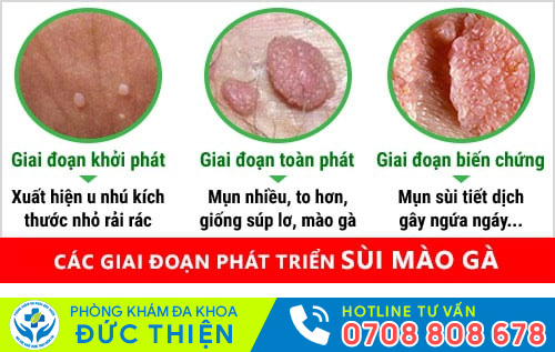 Các giai đoạn phát triển của sùi mào gà