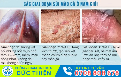 Thời gian ủ bệnh sùi mào gà ở nam tương đối dài