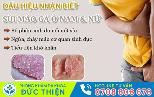 Bệnh sùi mào gà