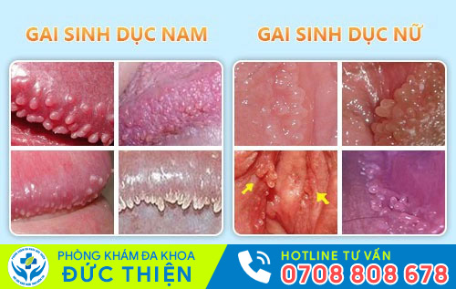 Gai sinh dục