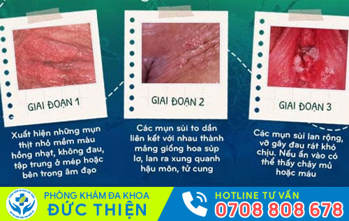 Biểu hiện sùi mào gà qua 3 giai đoạn bệnh