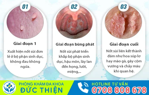 giai doan phat trien benh sui mao ga