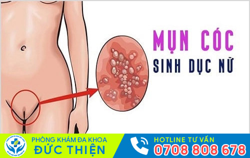 Mụn rộp sinh dục ở cơ quan sinh dục nữ