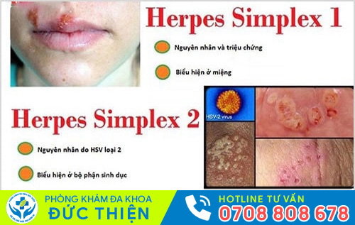 Virus HSV gây mụn rộp sinh dục gồm 2 loại: Type 1 và 2