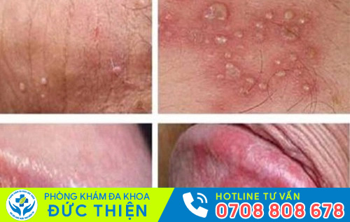 Triệu chứng mụn rộp sinh dục nam