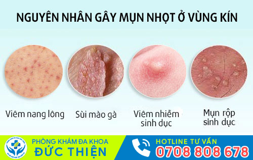 Một số nguyên nhân gây mụn nhọt vùng kín