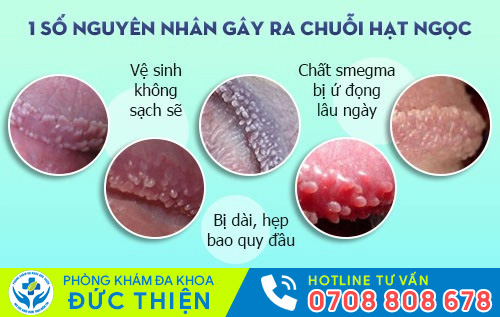 Hình ảnh chuỗi hạt ngọc dương vật