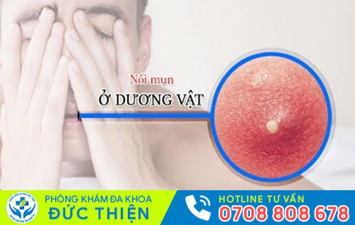 Nổi mụn ở dương vật