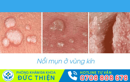 Hình ảnh nổi mụn ở vùng kín