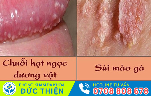 Phân biệt chuỗi hạt ngọc dương vật và sùi mào gà