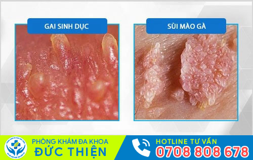 Phân biệt gai sinh dục và sùi mào gà