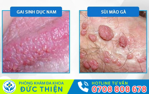 Biểu hiện gai sinh dục và sùi mào gà