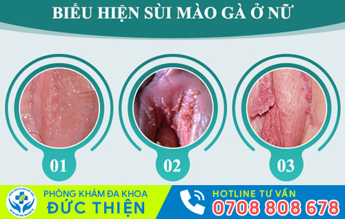Sùi mào gà ở âm đạo