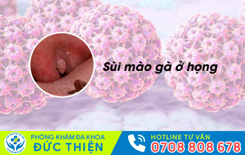 Sùi mào gà ở họng