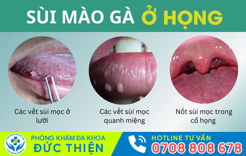 Sùi mào gà ở họng